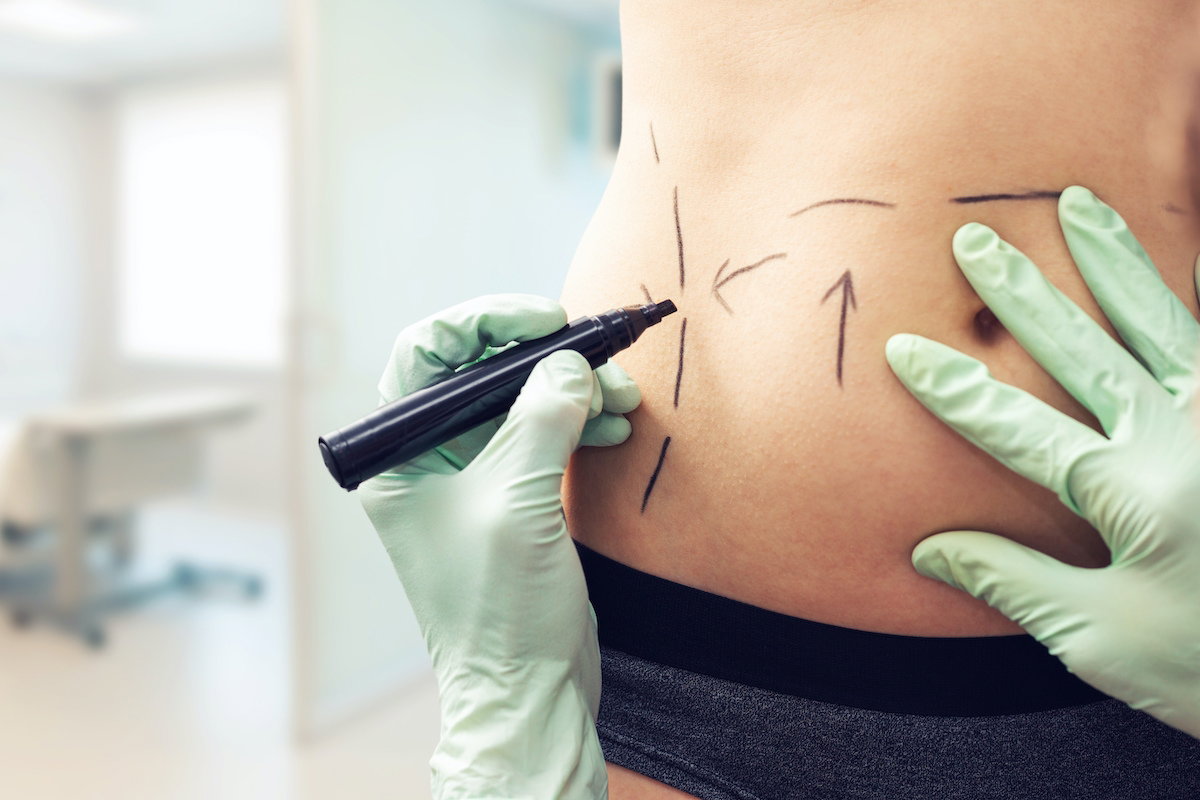 Lipoaspiração: tudo o que você precisa saber sobre a cirurgia estética