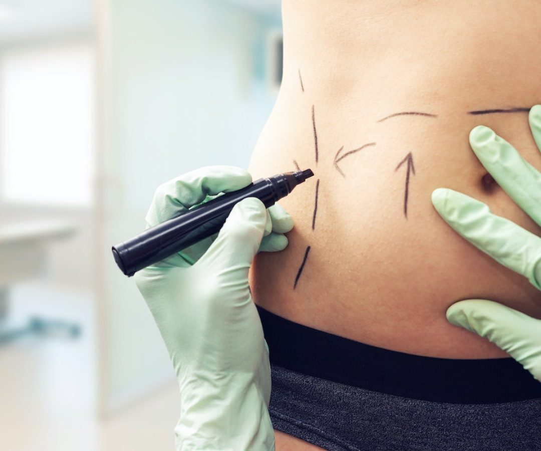 Lipoaspiração: tudo o que você precisa saber sobre a cirurgia estética