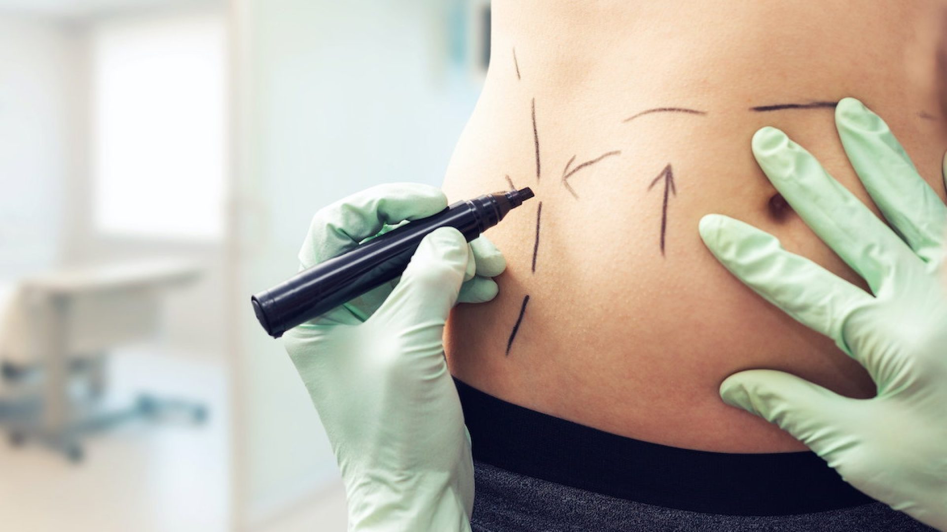 Lipoaspiração: tudo o que você precisa saber sobre a cirurgia estética